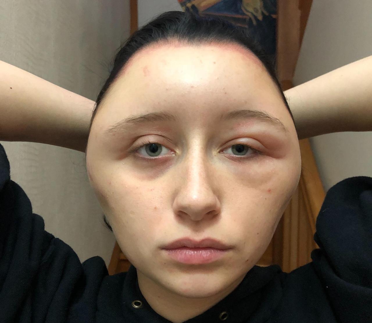 Woman Suffers Allergic Reaction From Hair Dye Jpg   Woman Suffers Allergic Reaction From Hair Dye 